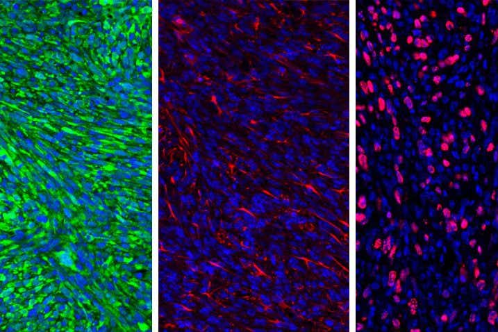Brain cancer immunotherapy in mice more effective with drug coating